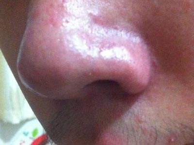 酒糟鼻有什么典型的症状